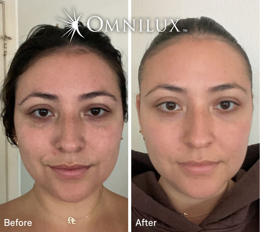 Omnilux Contour Face: Red LED Light Mask for Anti-Aging