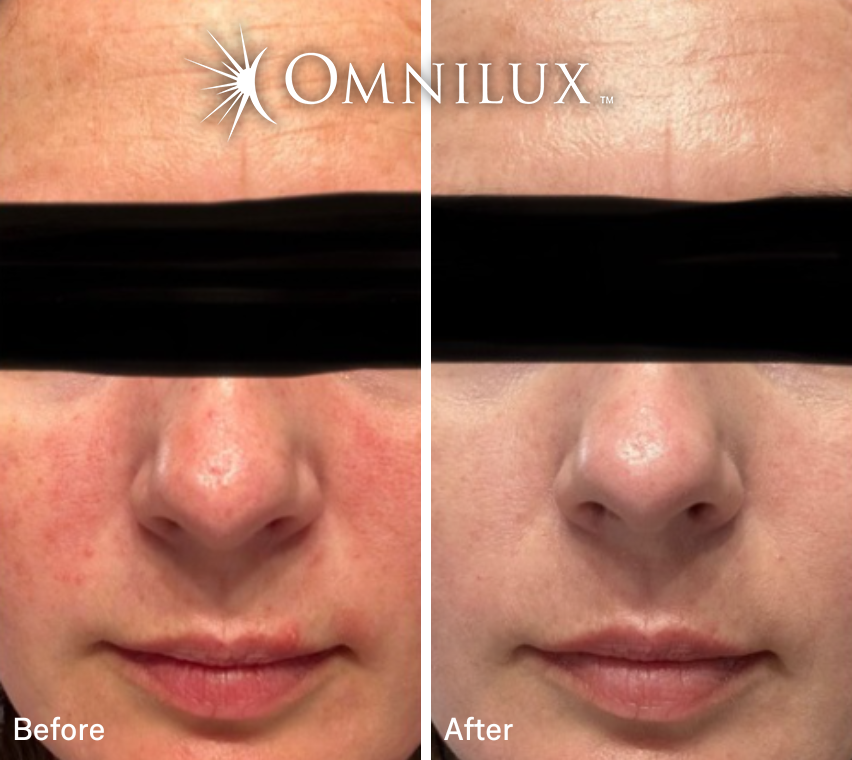 Omnilux Contour Face: Red LED Light Mask for Anti-Aging